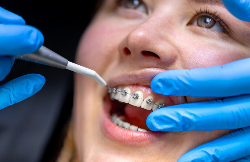 Diş Teli Tedavisi: Fiyatları, Aşamaları, Sık Sorulan Sorular ve Merak Edilenler