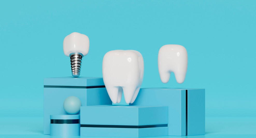 İmplant Tedavisi: İmplant Fiyatları 2026, Aşamaları, Ucuz İmplant Seçenekleri ve Merak Edilenler